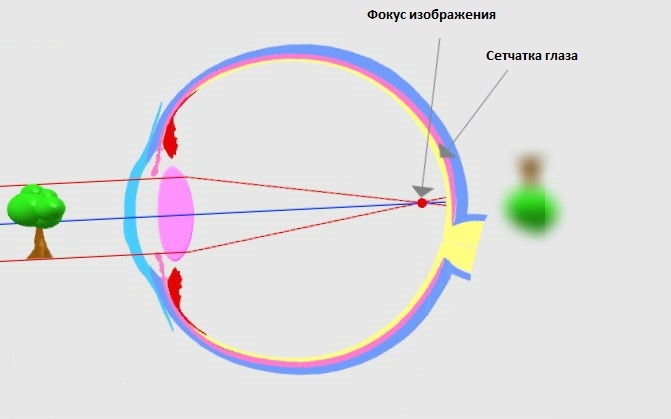 Фокус это. Близорукость ось глаза. Фокус зрения. Осевая и рефракционная миопия. Фокус изображения на сетчатке.