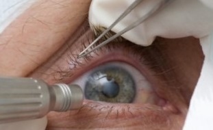 Все методы лечения катаракты в Центре глазной хирургии