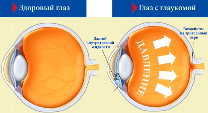 Что такое глаукома и методы её лечения