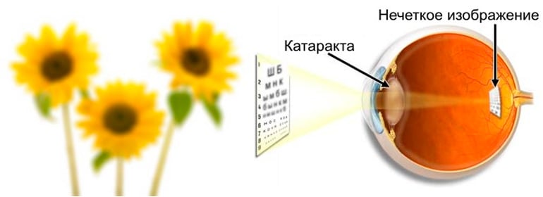 Статья на тему Что такое катаракта Международный центр охраны зрения по лечению глаз, коррекции и восстановлению зрения при помощи лазера.