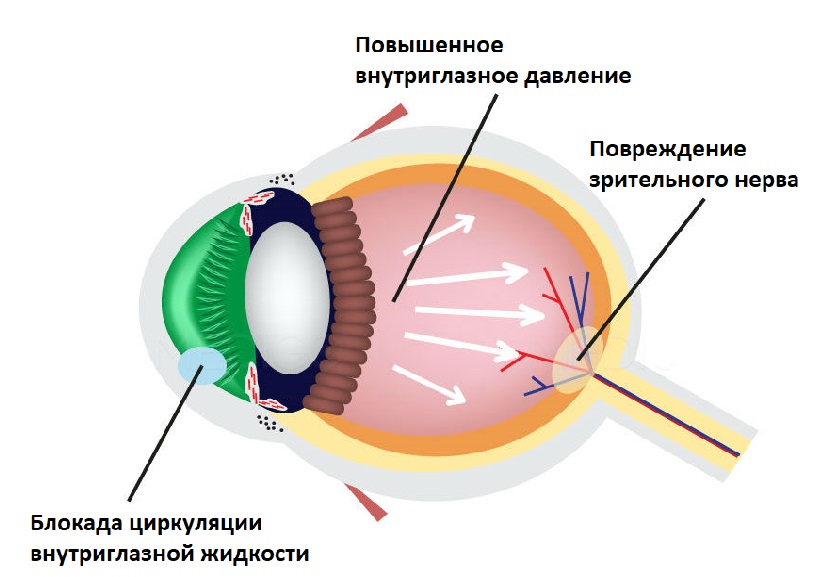 Лечение глаукомы лазером в клинике Прозрение