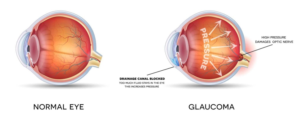 Лечение глаукомы: лекарственные средства, глазные капли и многое другое